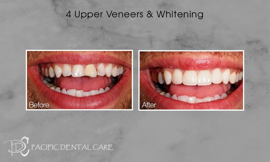 4 Upper Veneers and Whitening Before and After