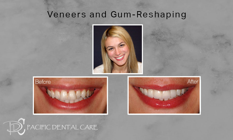 Veneers and Gum Reshaping Before and After